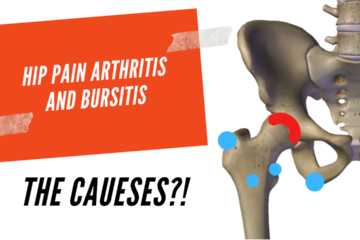 hip pain arthritis bursitis